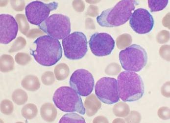 acute leukemia all